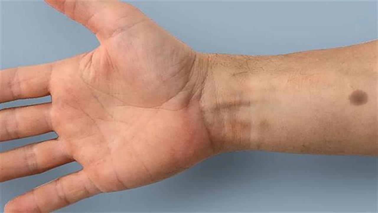 Εμφύτευμα προειδοποιεί για καρκίνο!