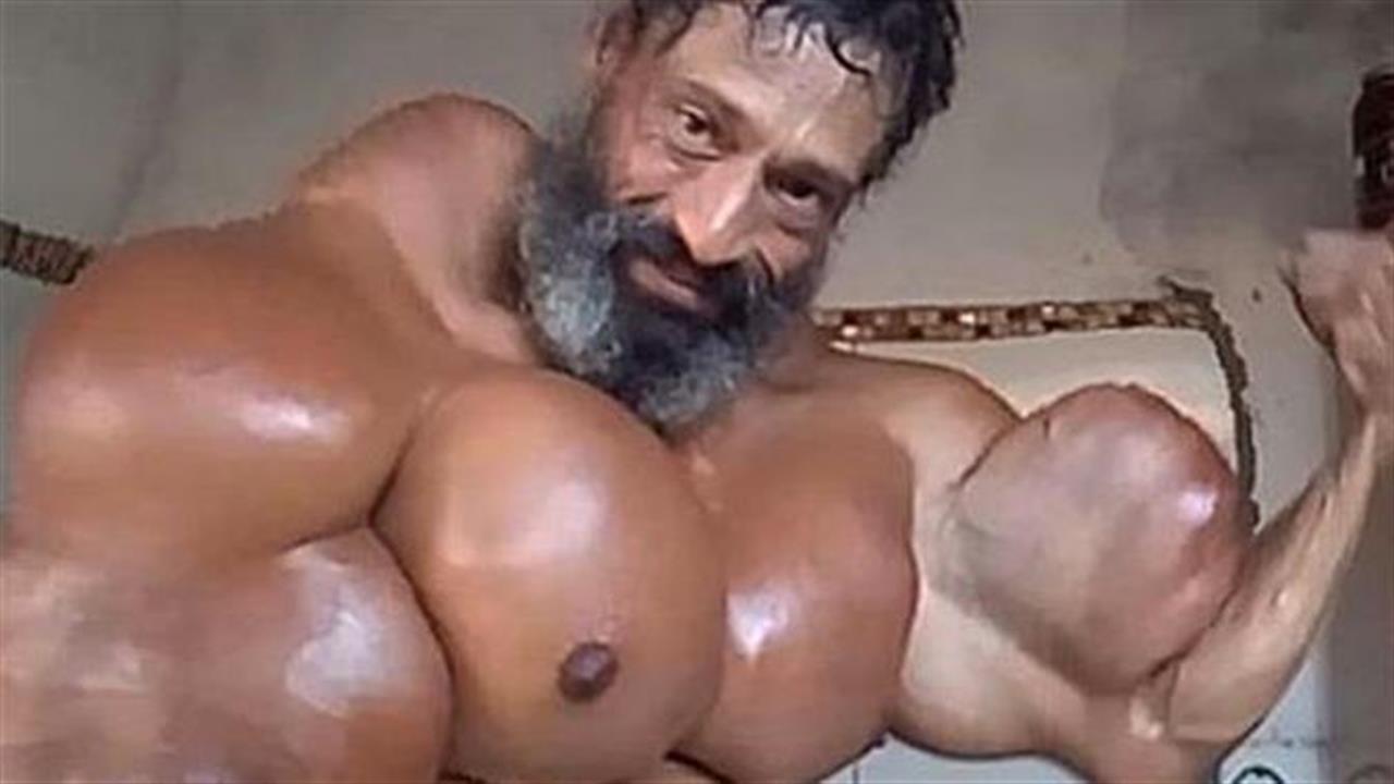 Πέθανε ο Βραζιλιάνος Hulk που φούσκωνε τα μπράτσα του με ενέσεις λαδιού