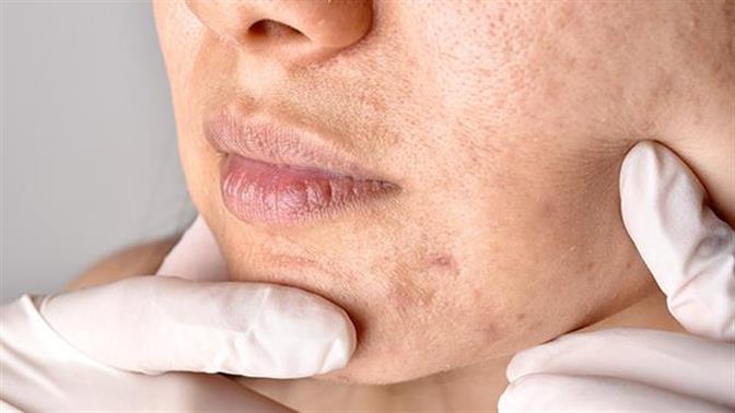 Οι πιο συχνές δερματικές παθήσεις