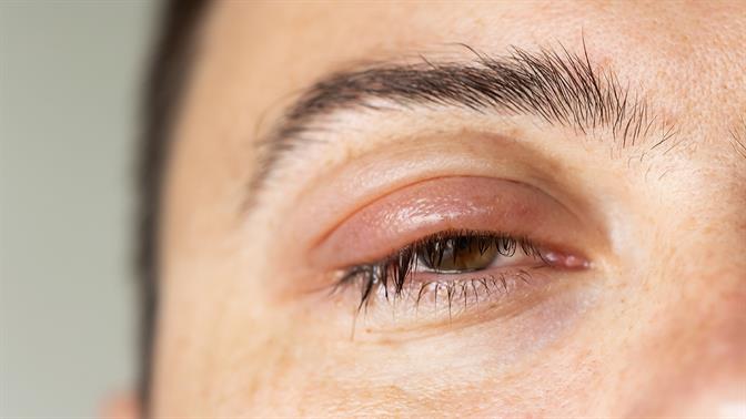 Βλεφαρίτιδα: Τι είναι και πώς συνδέεται με την υπερβολική χρήση οθονών